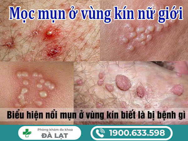 Vùng kín nổi mụn nguyên nhân do đâu và cách điều trị?